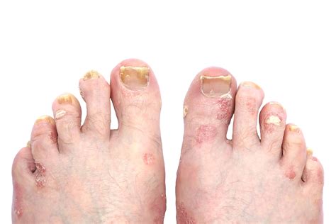 Psoriasis and Psoriatic Arthritis of the Toe Nails and Feet | A Step ...