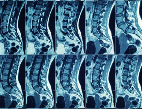 You Are Not Defined By Your MRI Results - PT Solutions