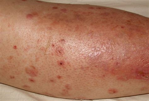 Diabetic sores on legs images | Symptoms and pictures