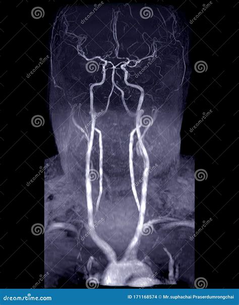 MRA Brain and Neck or Magnetic Resonance Angiography MRA of Cerebral ...