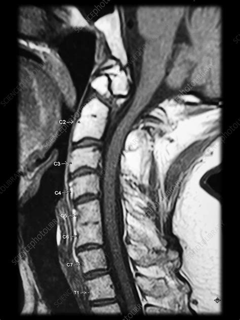 Os Odontoideum MRI - Stock Image - C043/0220 - Science Photo Library