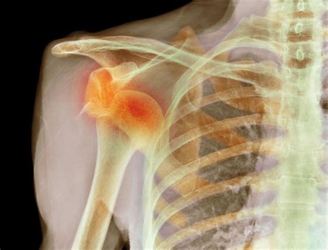 Shoulder Dislocation Symptoms and Treatment