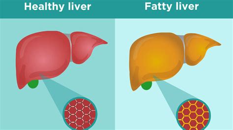 Fatty Liver (Hepatic Steatosis): Most Common Signs and Symptoms – Page ...