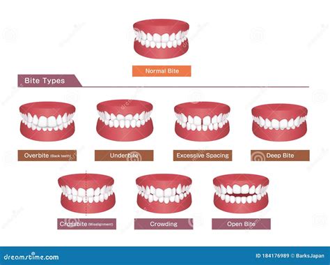 Anterior Crossbite Dental Occlusion Malocclusion Of Teeth . Medically ...