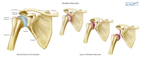 Dislocated Shoulder Rehab Exercises | EOUA Blog