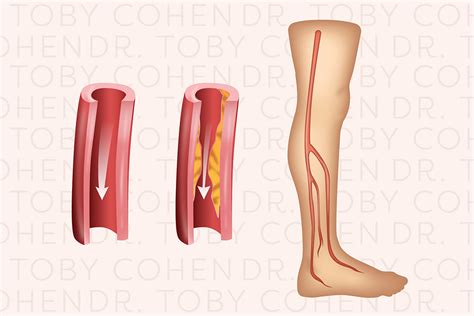 Peripheral Artery Disease Rash