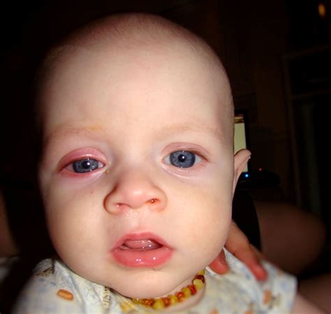 Causes and Treatment for Conjunctivitis in Babies | New Health Advisor