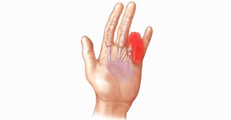 Trigger Finger Physiotherapy Rehabilitation