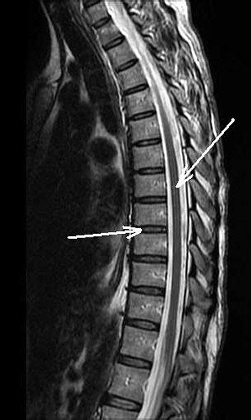 Anatomy of the Thoracic Spine | Spine Anatomy | Colorado