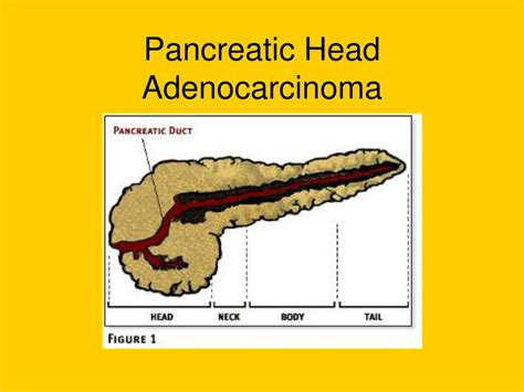 PPT - Periampullary and Pancreatic Tumors PowerPoint Presentation - ID ...