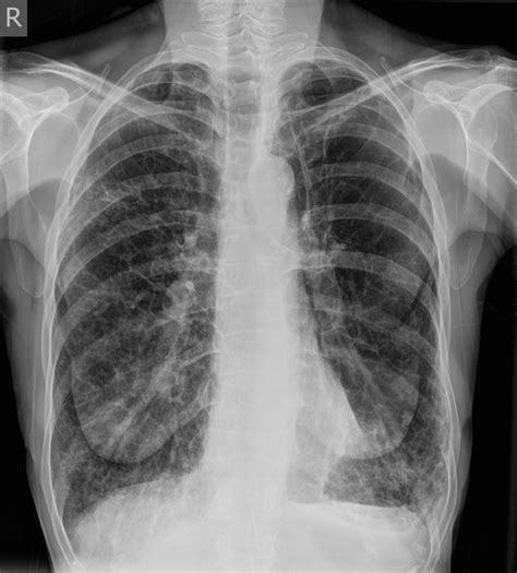 Emphysema Chest X Ray