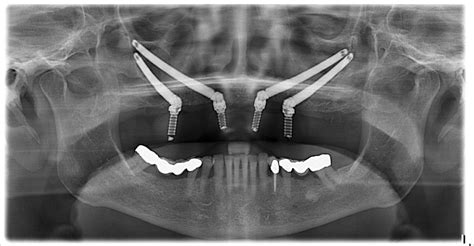 Zygoma Implants Treatment & Cost In Hyderabad | Alux Dental