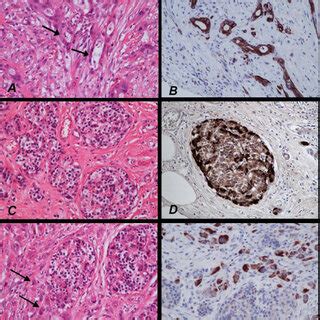 Histology and immunoprofile of pancreatic type adenocarcinoma. The ...