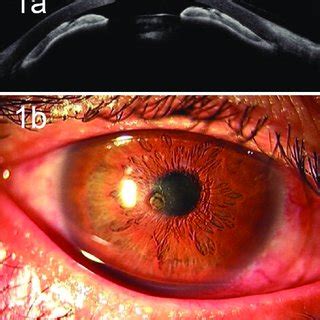 Preoperative images of the paracentral corneal perforation. a) The ...