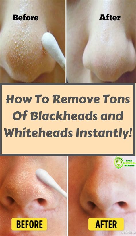 How To Remove Blackheads In Home Remedies - HOWOTREMVO