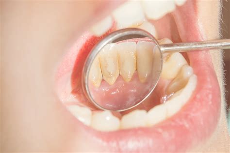 Dental Tartar (Calculus) - Causes, Prevention and Removal