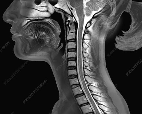 Cervical spine and brainstem, MRI scan - Stock Image C037/1654 ...