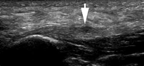 Partial plantar fascia tear. Longitudinal US image shows disruption of ...