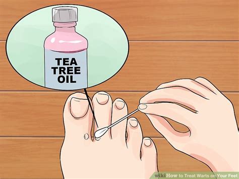 How to Treat Warts on Your Feet: 11 Steps (with Pictures)