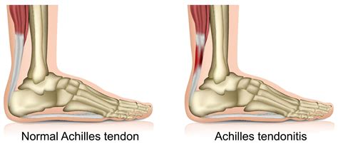 Achilles tendonitis (tendinopathy) | Southern Cross NZ