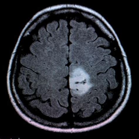 Brain Tumor MRI Image Classification | Kaggle