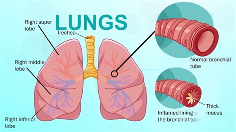 13 Common Bronchitis Symptoms & Signs With Treatment