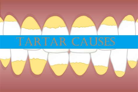 What Causes Tartar Buildup On Your Teeth? » 2024