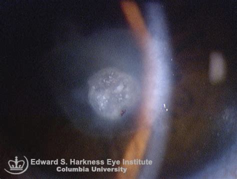 Corneal Perforation | Vagelos College of Physicians and Surgeons