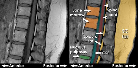 MRI interpretation - T1 v T2 images