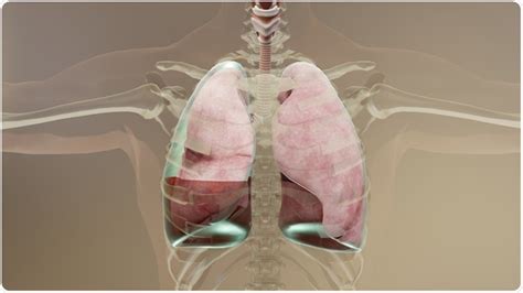 Empyema Diagnosis