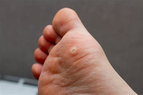 Plantar warts – Arizona Foot Doctors