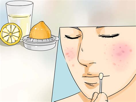 Neat Tips About How To Cure Pimples - Petertrade29