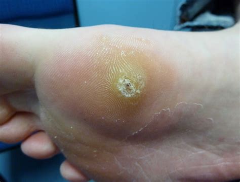 Plantar Warts – brightonpodiatry.com.au