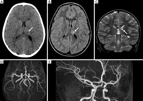 Head CT, brain MRI and MR angiography (MRA) at clinical onset. (A ...