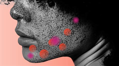 Cystic Acne: How to Treat and Prevent Breakouts — Expert Tips | Allure