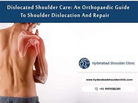 Dislocated Shoulder Care: An Orthopaedic Guide To Shoulder Dislocation ...