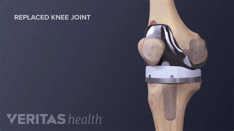 Total Knee Replacement Surgery Recovery Timeline - Althealth