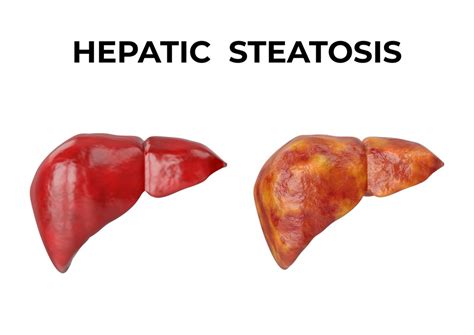 What Causes Hepatic Steatosis? | Ben Crump Law, PLLC