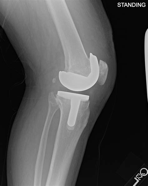 Case Study: Left Total Knee Replacement - 63 year old Female