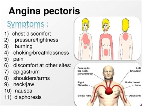 Angina pectoris by student at ahram canadian university