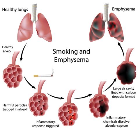 Stage 2 emphysema symptoms – Prnso