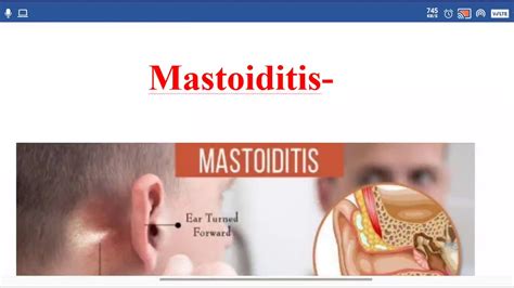 Mastoiditis full explanations - YouTube