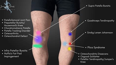 Knee Pain Area Chart – NBKomputer