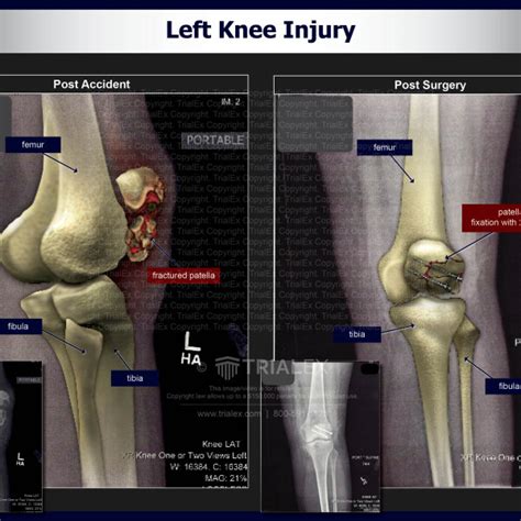 Left Knee Surgery - TrialExhibits Inc.