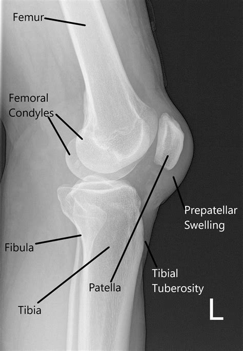 Lateral Knee X Ray Positioning