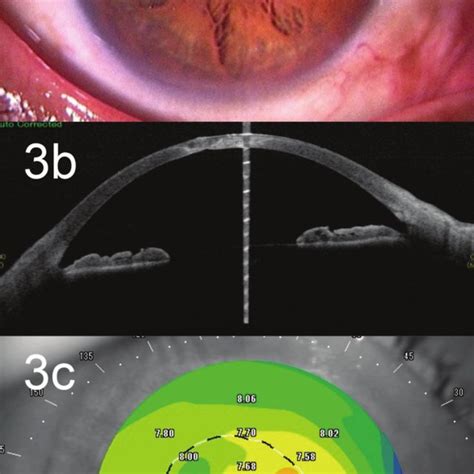 Postoperative images of paracentral corneal perforation. a) The corneal ...