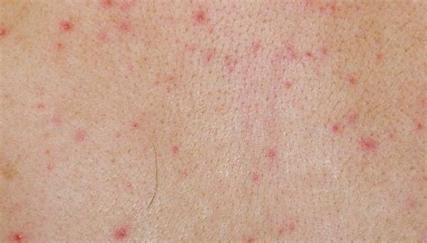 Skin Rashes Caused by Viral Infection | Healthy Living