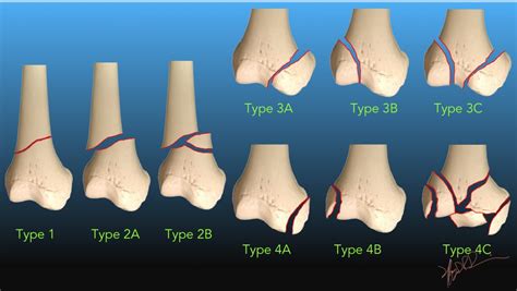 Medial Femoral Condyle Fracture