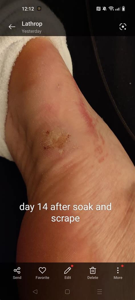 Plantar wart duct tape progress. : r/Warts