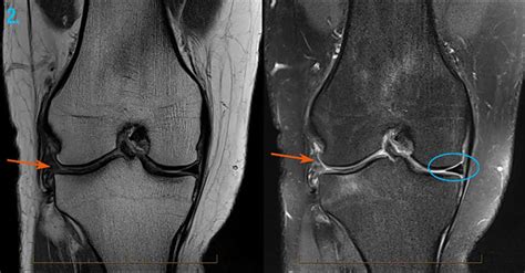 MRI Scan Knee Melbourne - Melbourne Radiology Clinic